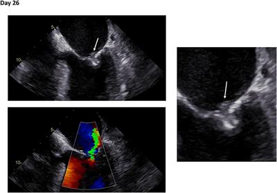 Case Report: Living on the Edge—Transcatheter Mitral Valve Repair Related Infective Endocarditis